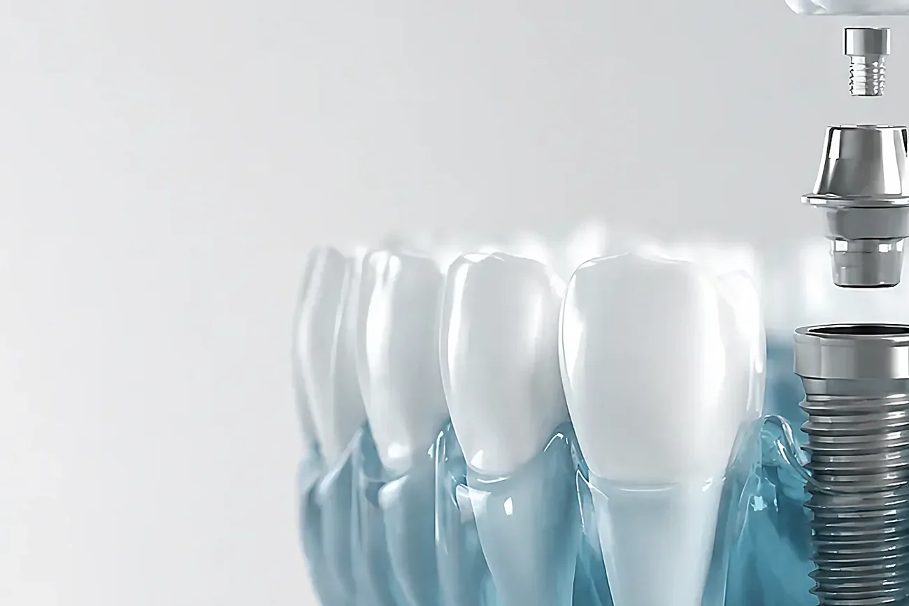 A dental implant being placed into a model of the jaw