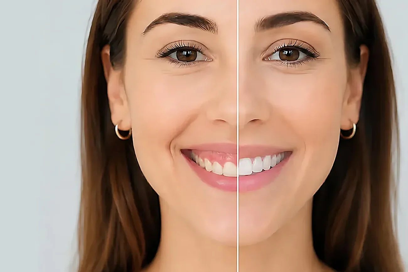 A before-and-after comparison of one patient's smile