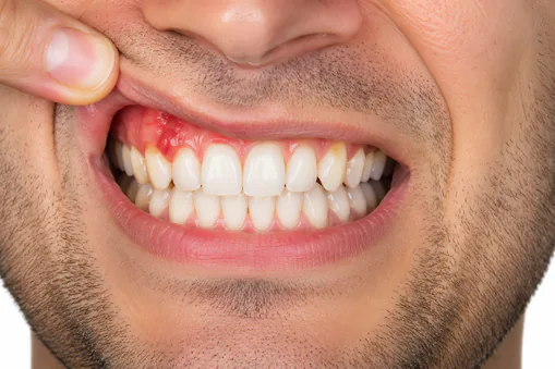 A close-up of red, inflamed gums