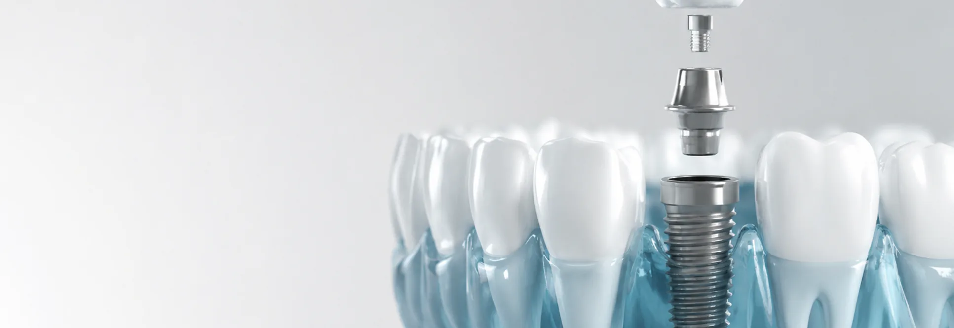 Computer guided dental implants at Charlottesville Dental Care