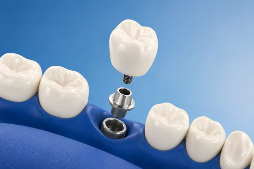 Illustration of an implant post, abutment and crown filling a gap between teeth