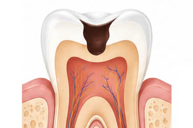 Illustration of a tooth with a cavity