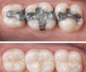 Back teeth with metal fillings, above the same teeth with tooth-colored fillings