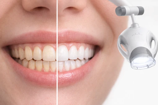 A smile shown before and after whitening, beside a whitening lamp