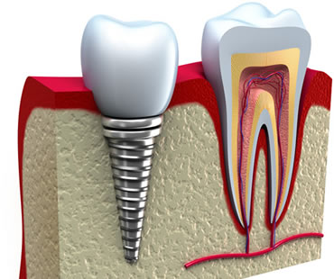 dental implants dentist in Charlottesville