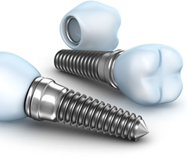 Implant dentist in Charlottesville