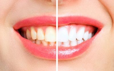 Perfecting your Pearly Whites: How Cosmetic Dentistry Can Transform Your Smile