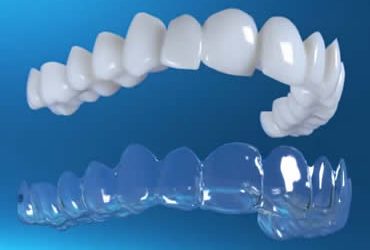 Frequently Asked Questions About Invisalign